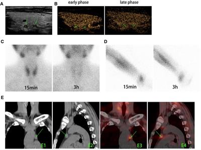Recurrent renal secondary hyperparathyroidism caused by supernumerary mediastinal parathyroid gland and parathyromatosis: A case report